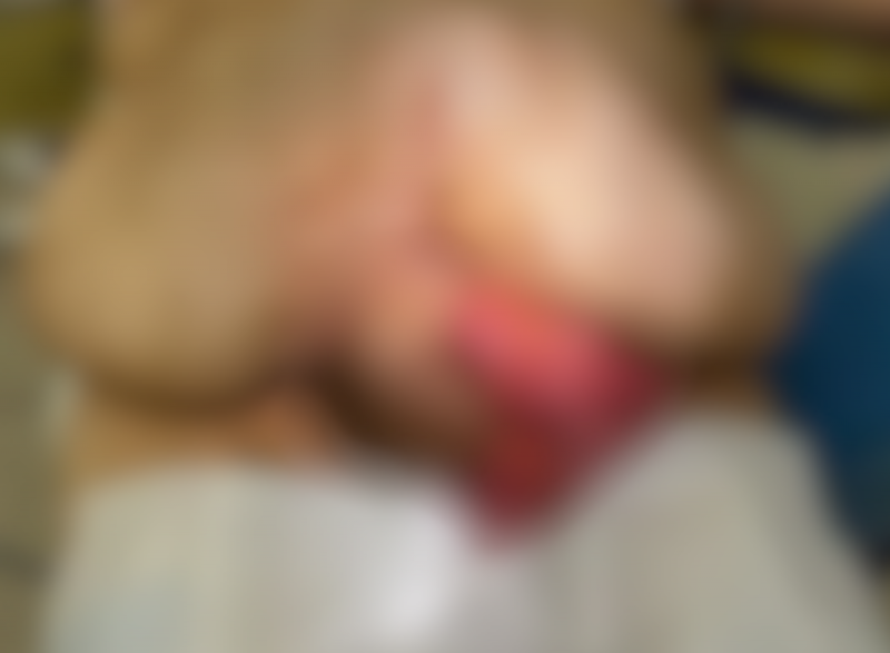 Mulher tem intestino expelido para fora