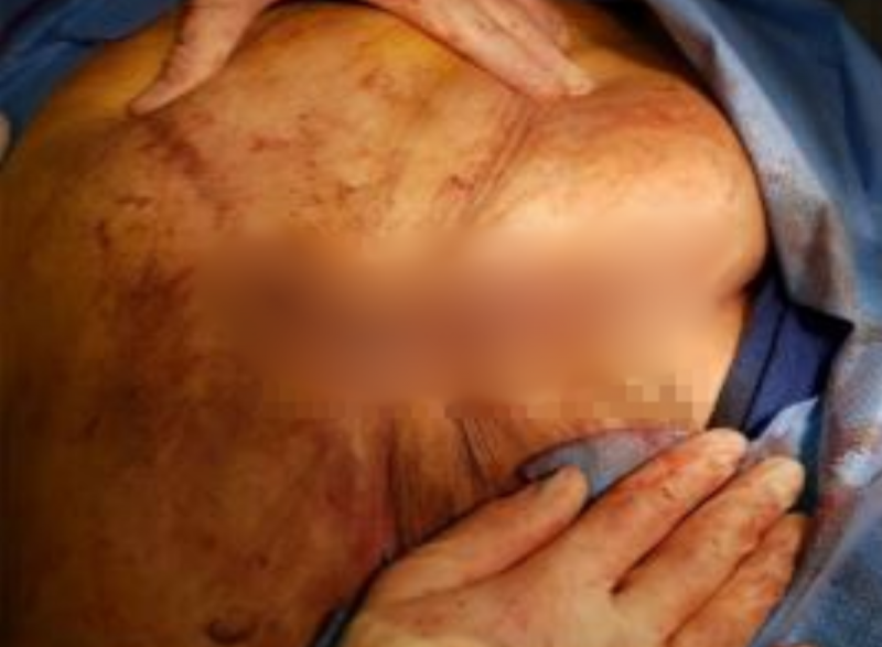 O caso onde o intestino de mulher &eacute; jorrado para fora de seu corpo &eacute; considerado raro – Foto: Reprodu&ccedil;&atilde;o/ND