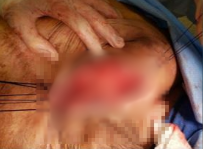 Intestino irrompeu por cicatriz antiga – Foto: Reprodu&ccedil;&atilde;o/ND