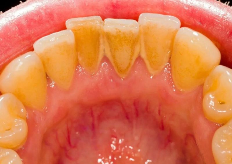 Mau hálito muitas vezes é causado por formação de tártaro