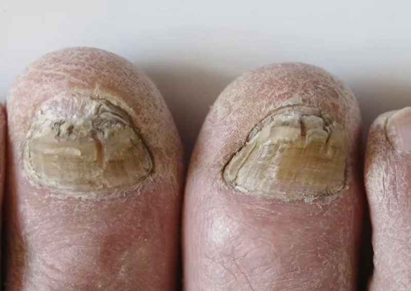 &Eacute; uma altera&ccedil;&atilde;o muito dif&iacute;cil de tratar, porque requer v&aacute;rios cuidados espec&iacute;ficos – Foto: Reprodu&ccedil;&atilde;o