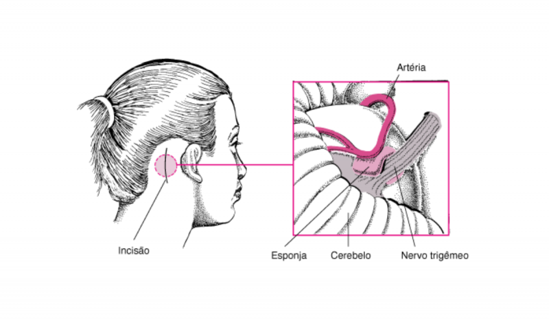 Ilustração de procedimento para tratar neuralgia do trigêmeo