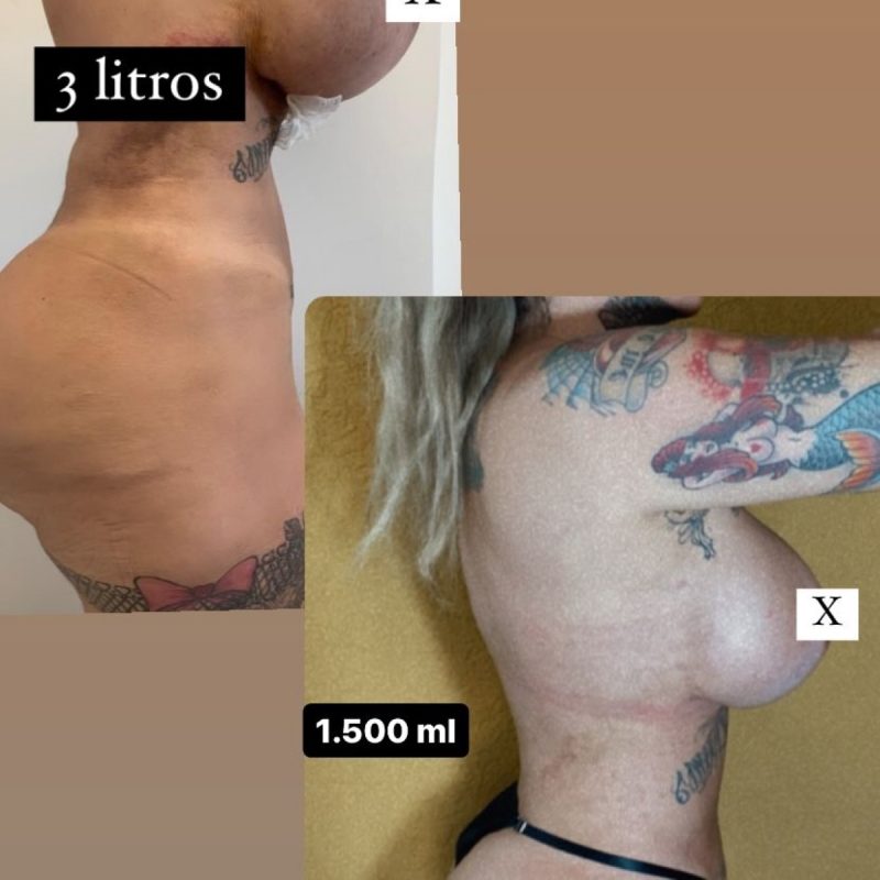 Sabrina Boing Boing aparece com resultado da cirurgia estética nos seios