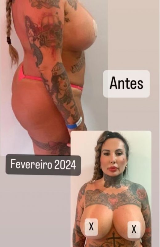 Sabrina Boing Boing aparece antes do resultado da cirurgia estética nos seios