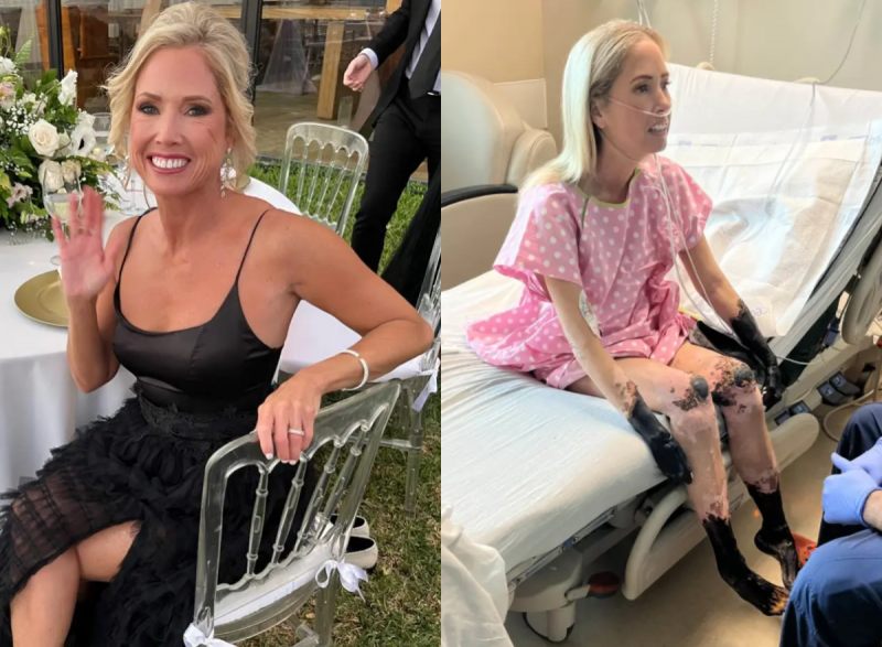 Sherri antes e depois de tratamento contra a pneumonia que avançou para sepse; medicamento acabou necrosando membros