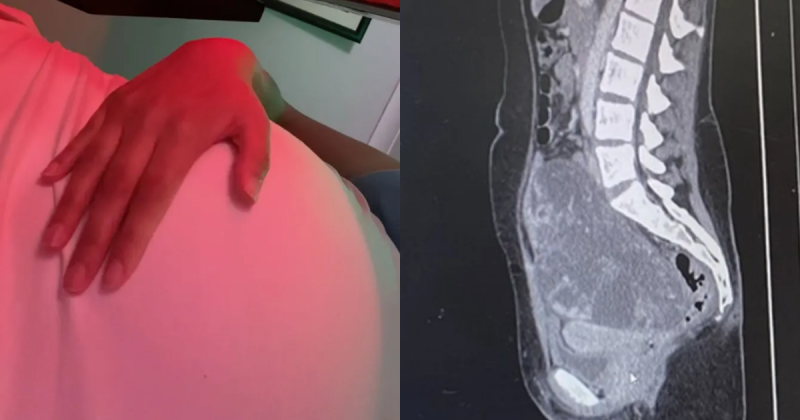 Na primeira imagem, a menina está com a mão na barriga e, na segunda, ela mostra o tumor que havia em sua barriga