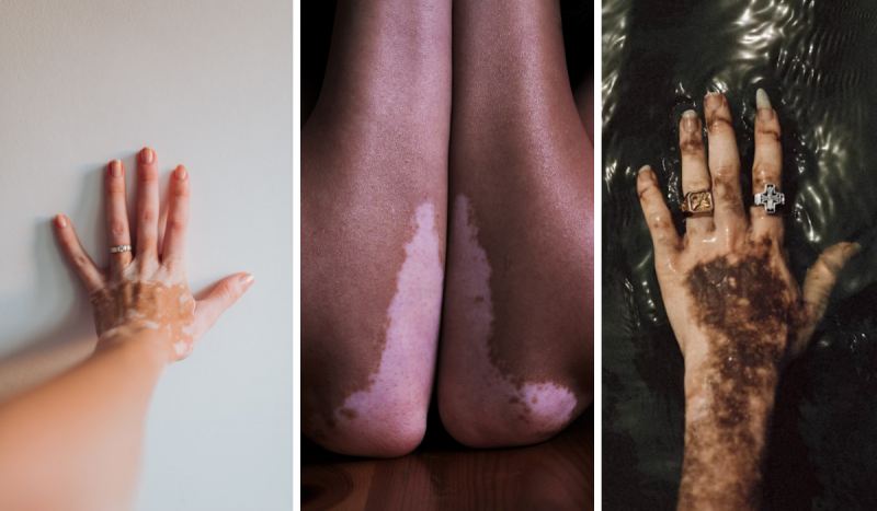 Fotomontagem com três imagens, todas de braços e mãos com vitiligo