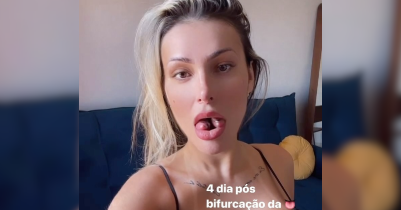 Andressa Urach em pós-operatório da língua