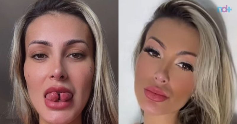 andressa urach aparece após realizar procedimento da bifurcação de língua