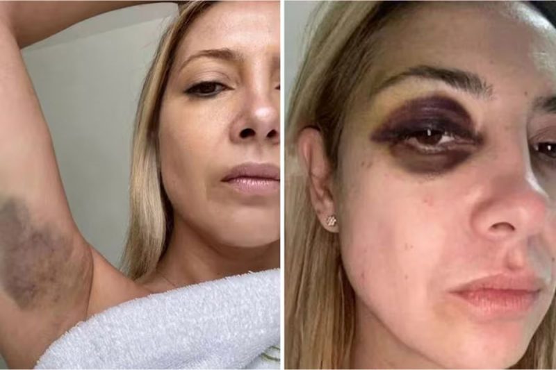 Ex-primeira-dama argentina aparece com hematomas em fotos vazadas