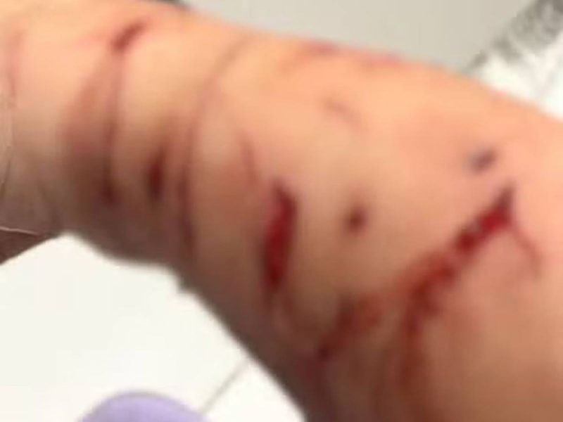 Ferimentos no braço Foto borrada do braço dilacerado da tutora que foi atacada pelo próprio gato