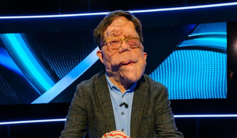 O ator Adam Pearson, 39, também já foi alvo de preconceito por conta de tumores no rosto causados ​​pela mesma doença – Foto: Instagram @adam_pearson_tv/Reprodução/ND