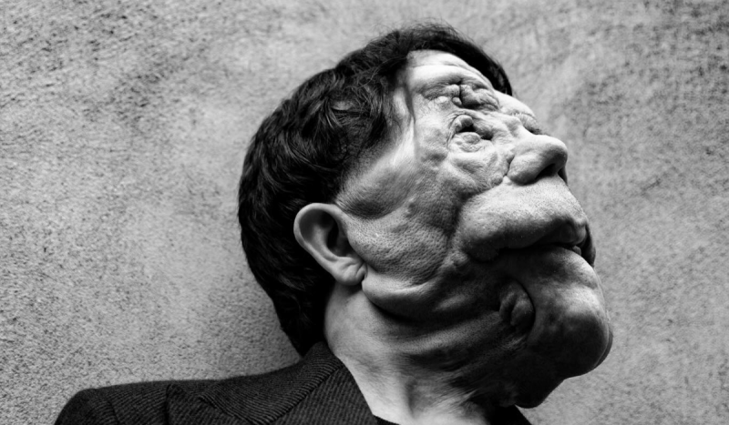 Ator britânico perdeu completamente a visão de um dos olhos devido a tumores no rosto – Foto: Instagram @adam_pearson_tv/Reprodução/ND