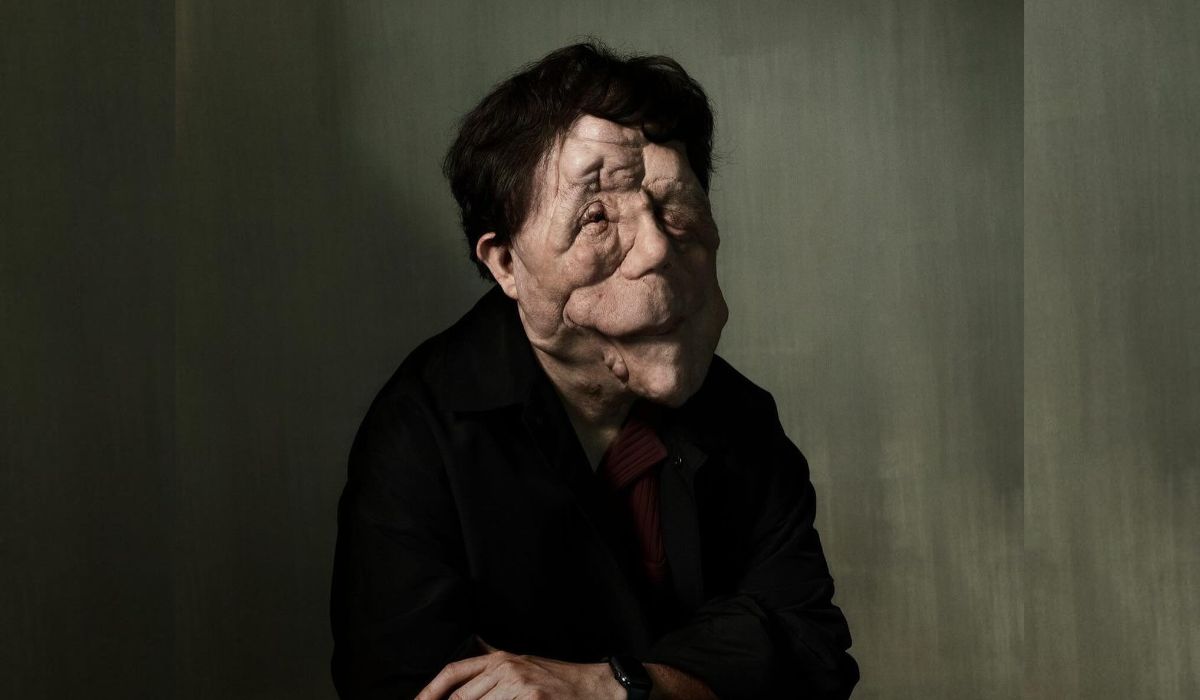 Pearson já contou que passou por diversos procedimentos cirúrgicos para retirada de tumores na região facial – Instagram @adam_pearson_tv/Reprodução/ND