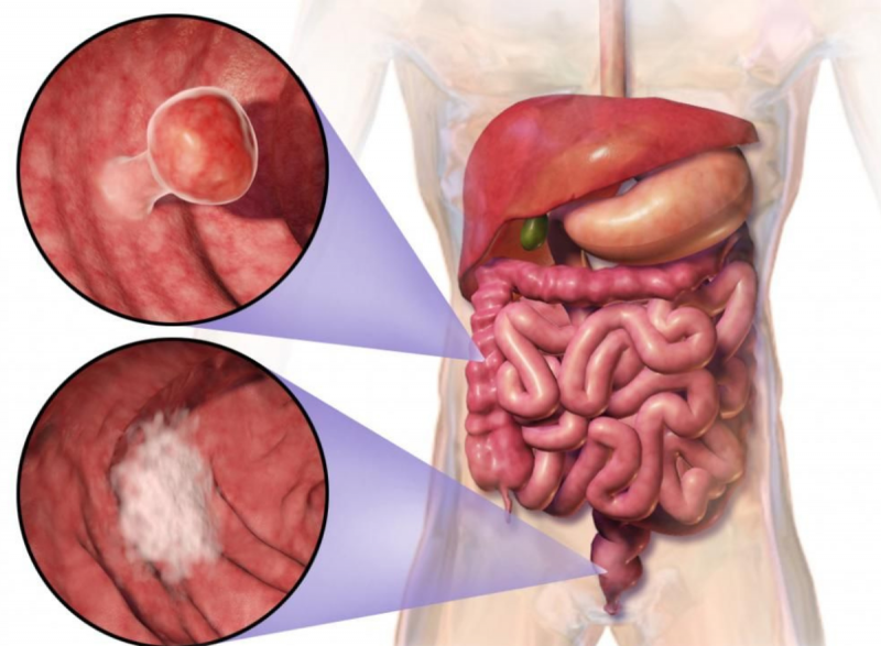 Imagem ilustrativa de câncer de intestino