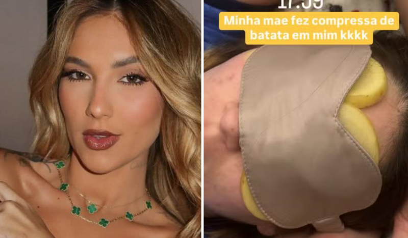 Virginia Fonseca fala sobre tratamento para a cefaleia - mulher branca e loira usando compressa com batata na testa