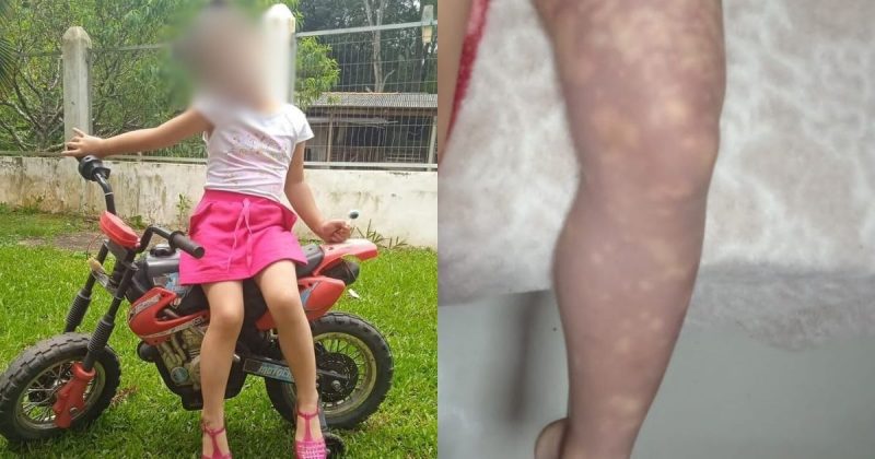 Menina de 4 anos teve perna amputada em SC após receber injeção