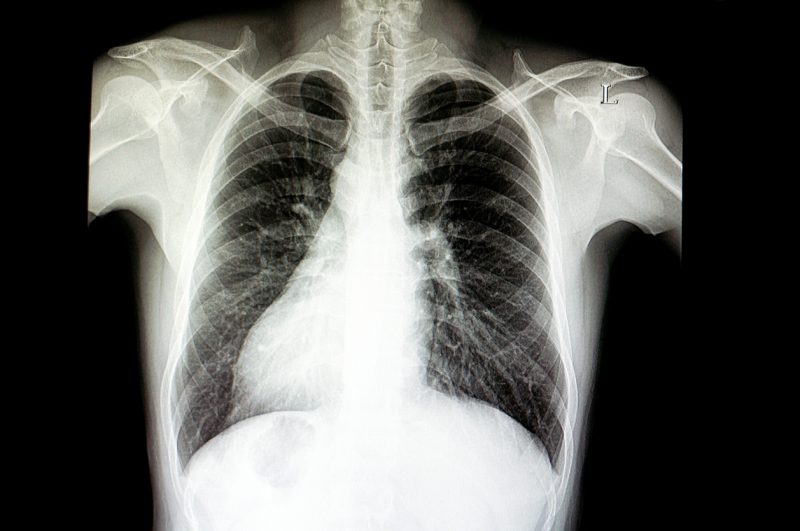 Radiografia mostrando o quadro de situs inversus totalis, com o coração do lado direito