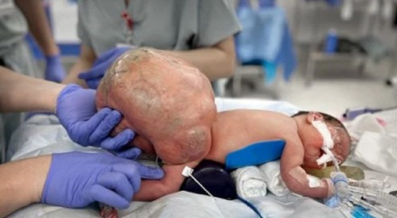 na imagem aparece o bebê que nasceu com tumor raríssimo quase com seu peso corporal