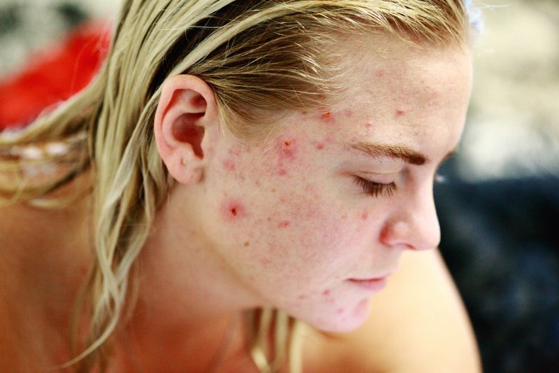 Descubra os alimentos que pioram a acne, segundo uma especialista &#8211; Foto: Pixabay/ND