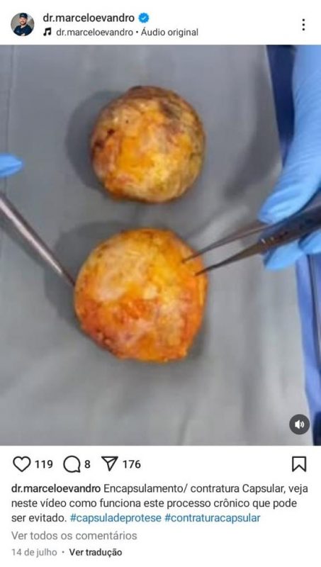 Cirurgião mostra bolas de gordura retiradas de paciente durante operação - Redes Sociais/ Reprodução/ ND