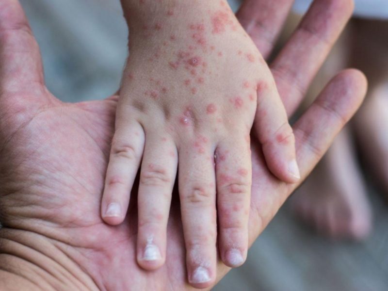 Mão de criança com síndrome mão-pé-boca