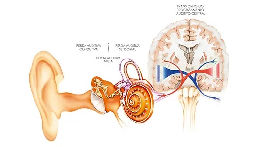 Transtorno do Processamento Auditivo Central