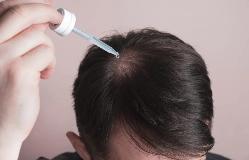 Bebês nascem com 'síndrome de lobisomem' após minoxidil