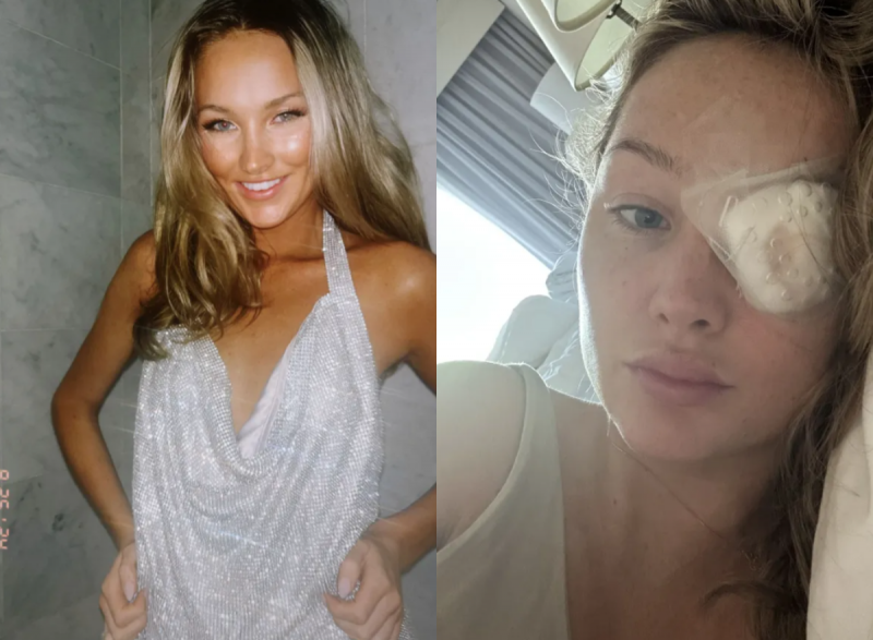 Antes e depois de jovem que foi atingida por bolsa da Dior 