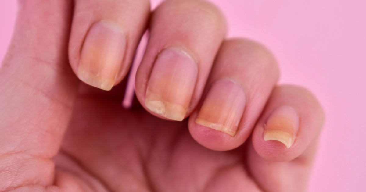 Observar a cor natural das unhas é a melhor forma de garantir que está tudo bem com a sua saúdeFoto: iStock/ND Mais