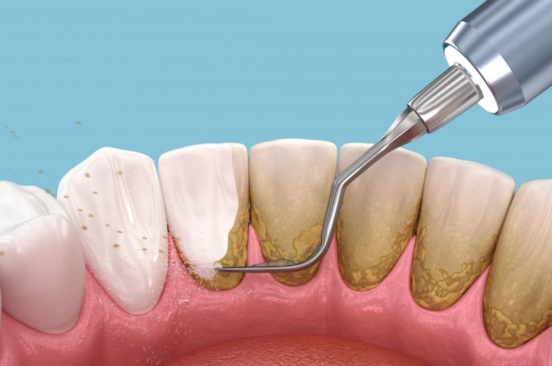 Higienização ajuda a remover o tártaro dos dentes