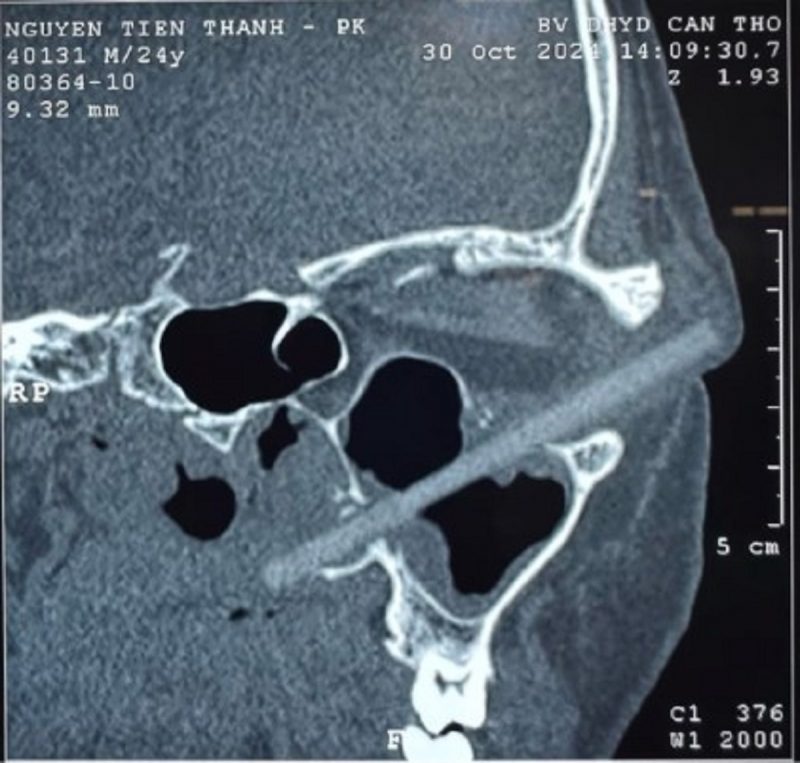 na foto aparece um pedaço de hashi dentro do olho do e um jovem após tomografia computadorizada