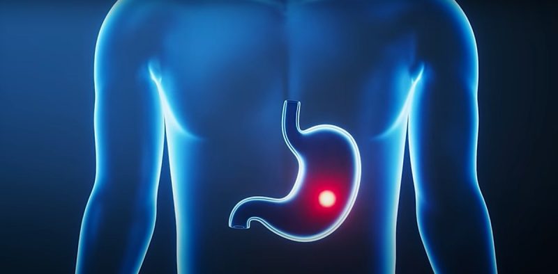 Vilões da gastrite: alimentos que agravam a situação