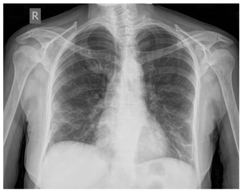 Radiografia pneumonia bilateral