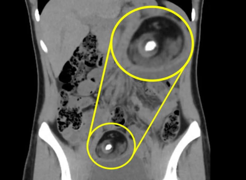 Tumor monstro em um exame de Nesli