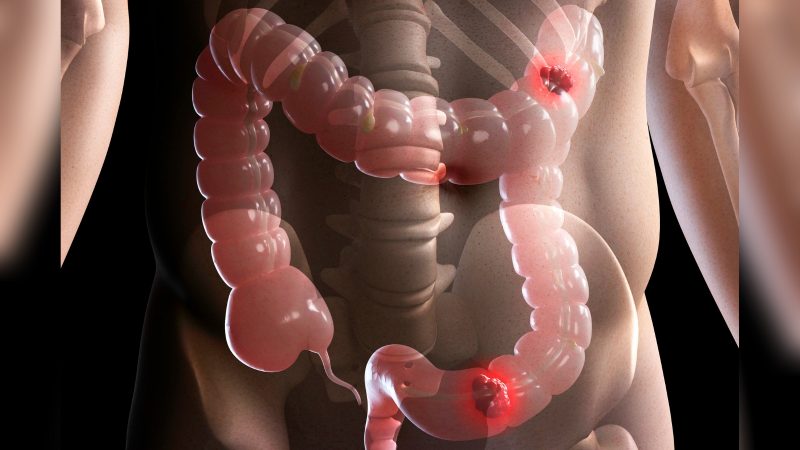 Imagem de intestino grosso em 3D com feridas