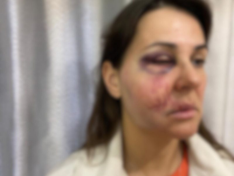 Tentativa de feminicídio Imagem mostra rosto de mulher machucado e olho roxo cheio de inchaço. Justiça aceita denúncia por feminicídio após mulher ser brutalmente agredida pelo ex-companheiro