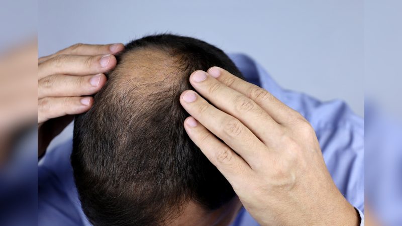 A queda de cabelo &eacute; uma preocupa&ccedil;&atilde;o comum. Apesar dos diversos tratamentos para conter ou reverter o problema, muitos tratamentos s&atilde;o caros e exigem um longo per&iacute;odo de uso – Foto: Canva/ND