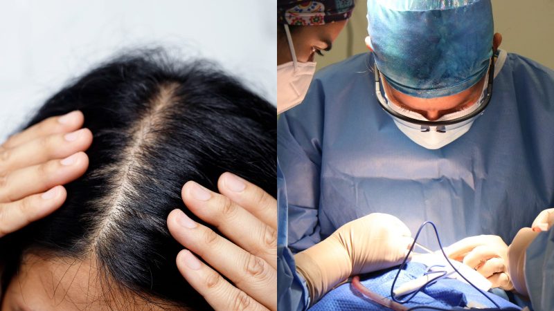 Em alguns casos, o paciente precisa raspar o cabelo Imagem de uma pessoa mostrando o couro cabeludo estilando os cabelos da cor preta. Ao lado, uma imagem mostrando um procedimento cirúrgico para ilustrar a matéria que explica se é necessário raspar o cabelo para o transplante capilar.