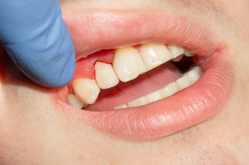 Como tirar tártaro do dente Dentista atendendo paciente para tirar o tártaro do dente