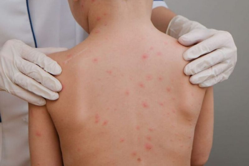 criança diagnosticada com meningite bacteriana