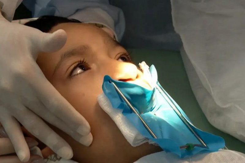 Lábio leporino Lábio leporino: pacientes terão cirurgia e tratamento gratuito pelo SUS