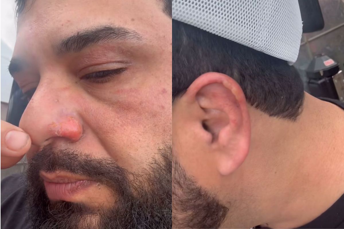 Acidente deixou queimaduras no nariz, orelha e na região do olho - @leo_leoeraphael/Instagram/ND