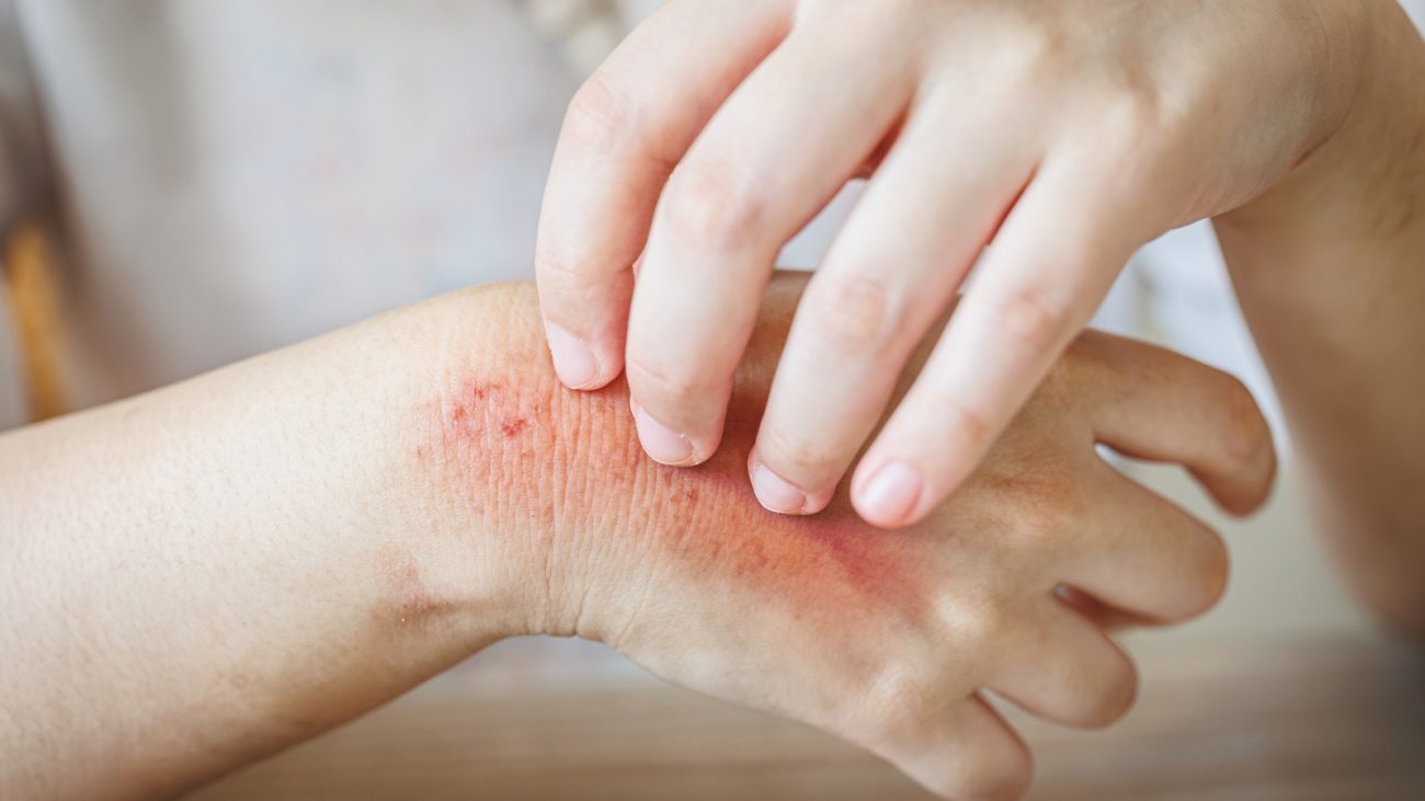 Reações alérgicas: algumas espécies de formigas, como a formiga de fogo, podem causar reações alérgicas ou asmáticas - reação alérgica formiga