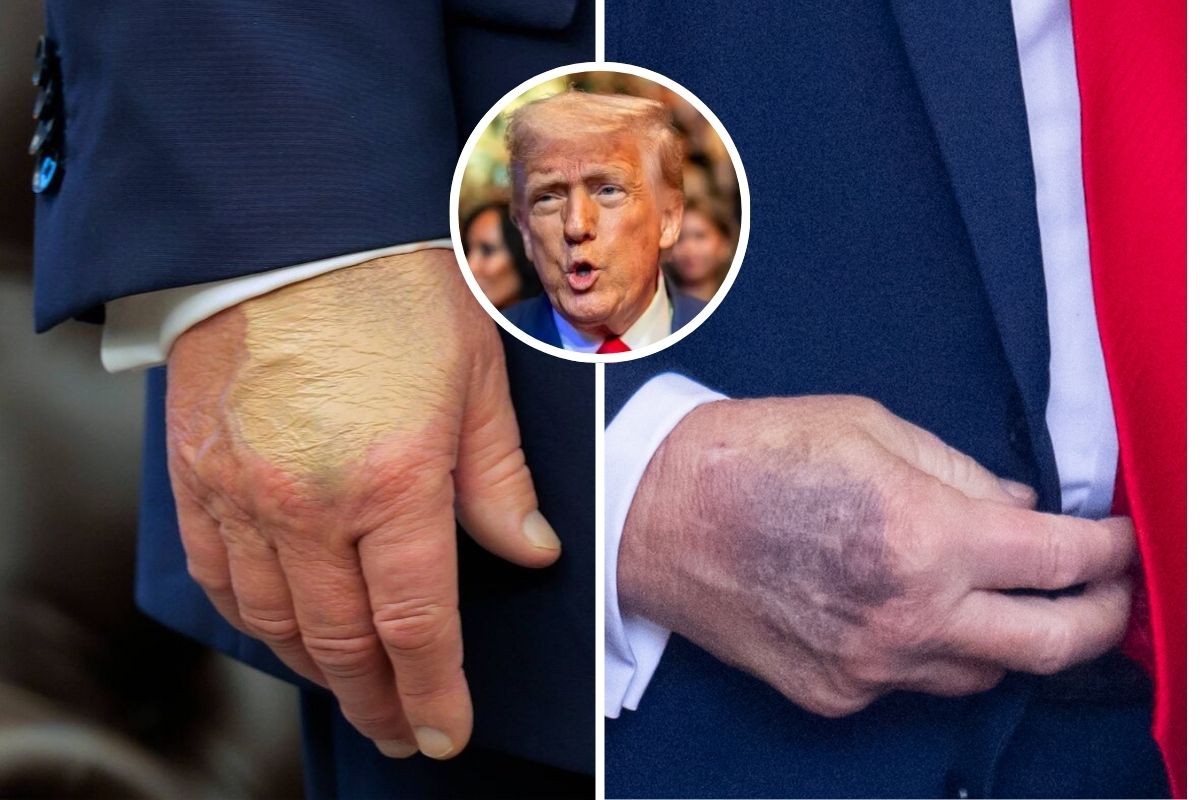 O que está por trás da mão roxa de Trump? Casa Branca explica