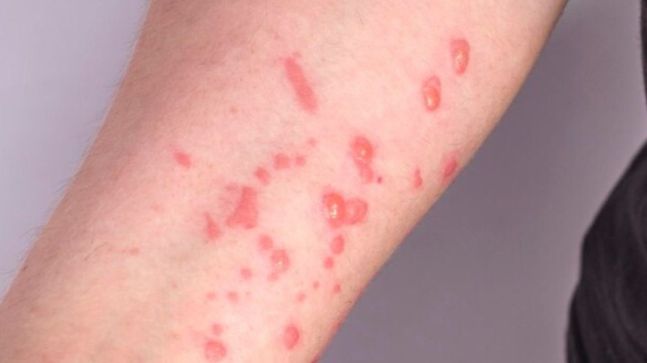 Sintomas da Mpox incluem o aparecimento de lesões na peleFoto: Freepik/ND Mais