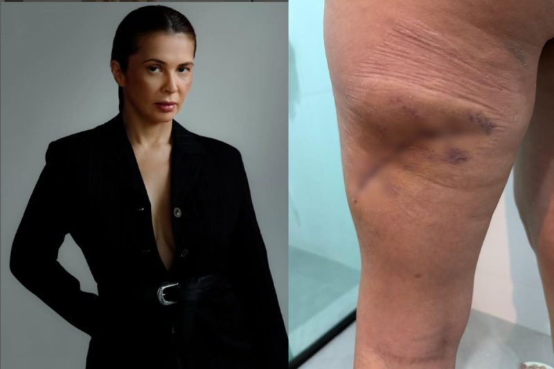 Modelo tem pele necrosada após procedimento estético em SC - Arquivi pessoal/ND