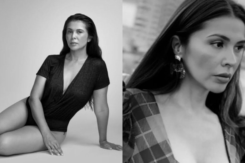 Modelo com a pele necrosada - Reprodução/Redes sociais/ND