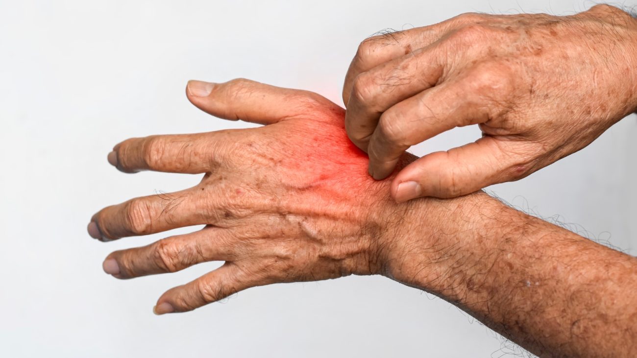 A picada de uma lacraia causa dor intensa, inchaço e vermelhidão, mas não são fataisFoto: Canva/ND Mais