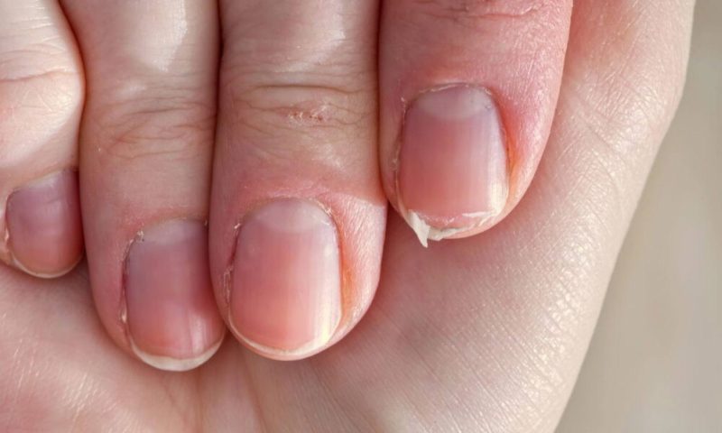 Sinal de alerta: o que suas unhas fracas e quebradiças estão tentando dizer